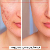 ژل کرم ضد جوش برند سینره